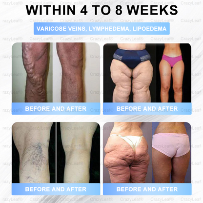 💜FDA Official Store| 𝐵𝑢𝑖𝑙𝑑𝑙𝑒𝑎𝑓® GLP-1 Nano-Microneedle Patch with Collagen & 𝑀𝑎𝑡𝑟𝑖𝑥𝑦𝑙 3000 丨𝑇𝑎𝑟𝑔𝑒𝑡𝑠 𝑂𝑏𝑒𝑠𝑖𝑡𝑦, 𝐿𝑜𝑜𝑠𝑒 𝑆𝑘𝑖𝑛, 𝐻𝑖𝑔ℎ 𝐵𝑙𝑜𝑜𝑑 𝑃𝑟𝑒𝑠𝑠𝑢𝑟𝑒, 𝐷𝑖𝑎𝑏𝑒𝑡𝑒𝑠, 𝐹𝑎𝑡𝑡𝑦 𝐿𝑖𝑣𝑒𝑟, 𝐽𝑜𝑖𝑛𝑡 𝑃𝑎𝑖𝑛, 𝐵𝑟𝑎𝑖𝑛 𝐹𝑜𝑔, 𝐿𝑜𝑤 𝐸𝑛𝑒𝑟𝑔𝑦, 𝐵𝑜𝑑𝑦 𝐴𝑐ℎ𝑒𝑠, 𝑎𝑛𝑑 𝑀𝑜𝑟𝑒🔥🔥